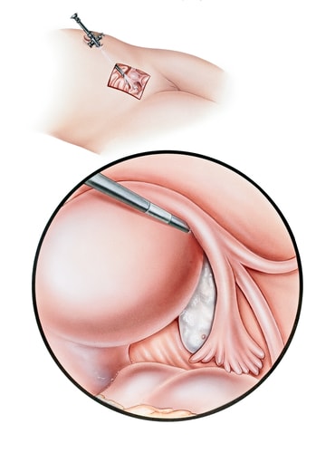 Cirugia Laparoscopica Minimamente Invasiva Barranquilla