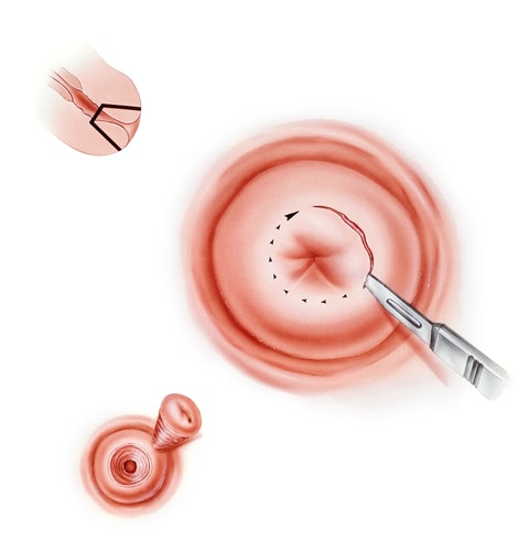 Conizacion de Cervix Barranquilla