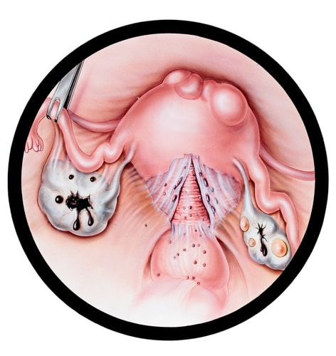 Endometriosis como puedes sospecharla Barranquilla