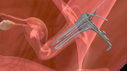 Histeroscopia Operatoria Barranquilla